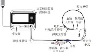 烟威首例!烟台毓璜顶医院心内一科团队用国产“心泵”为77岁高危患者打通“生命通道”