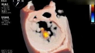 山东第一医科大学附属省立医院成功完成高难度全超声引导经皮二尖瓣钳夹手术