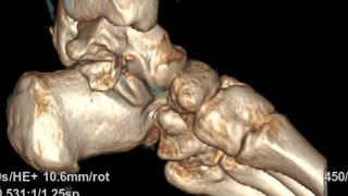 【北大名医在青岛】罕见左足“核心枢纽”距下关节脱位骨折,北大人民青岛医院骨科“院士团队”微创手术精准复位