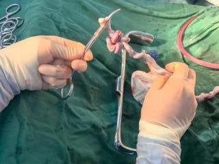 小叶医探 | 胎心监护反复异常,元凶竟是罕见脐带“双真结”