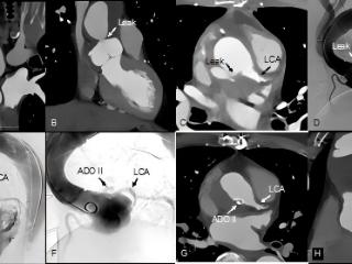 黄连军教授团队在主动脉外科术后吻合口漏介入治疗领域取得重要进展
