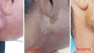 警惕!体表脓肿破溃?元凶竟是它!