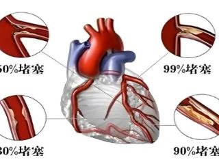 【科普】什么是急性心肌梗死？
