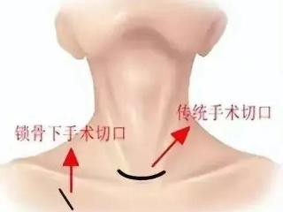 健康科普丨告别颈部瘢痕——经锁骨下腔镜甲状腺手术