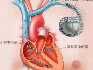 济南市中心医院成功实施可取出无导线起搏器植入手术