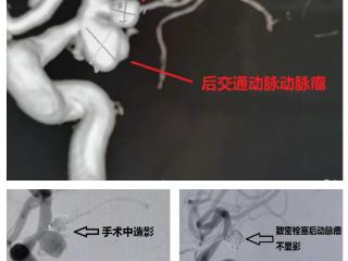颅内藏“炸弹”，“拆弹专家”解危难！泰安市第一人民医院精准实施颅内动脉瘤介入栓塞术