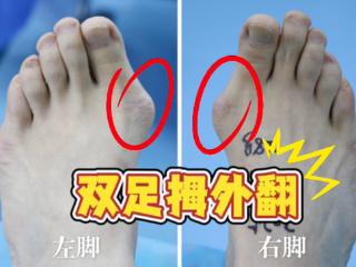济南关节外科医院超微技术30分钟矫正多年拇外翻，效果立竿见影