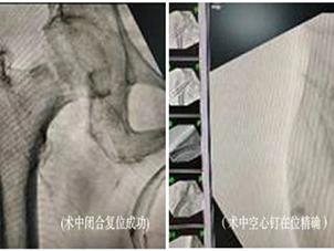 青岛市即墨区人民医院：“螺钉上的芭蕾”