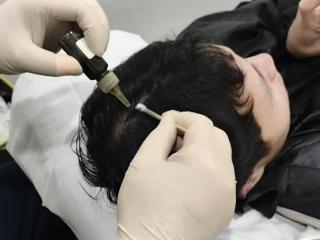 成都毛发专家吴元俊主任医师在中西医结合治疗脱发白发取得新突破