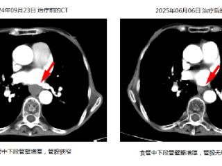 非手术治疗新突破！济南市五院成功帮助晚期食管癌患者重获新生