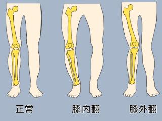 骨科专家科普膝关节炎导致的关节畸形——“O”型腿和“X”型腿