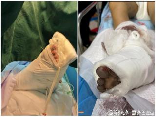 “只能截肢”到“脚保住了”1200公里外的医疗奇迹如何发生？