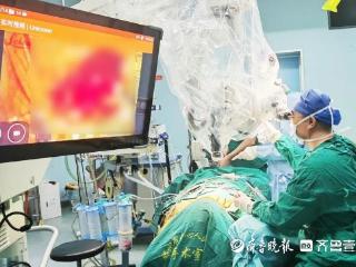滕州市中心人民医院神经外科二病区成功实施颈深淋巴-静脉吻合术