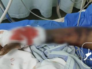 四川广汉一老人被蛇咬伤后引发“毒蛇跑失”等不实言论 主管部门辟谣：谣言中的蛇场已于近日搬离