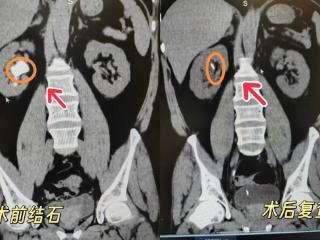 邹平市人民医院：无需开刀，泌尿结石现在可以“吸”出来
