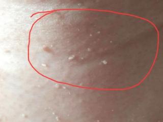 脖子上的“小肉揪”丝状疣大揭秘！济南市皮肤病防治院温馨提示