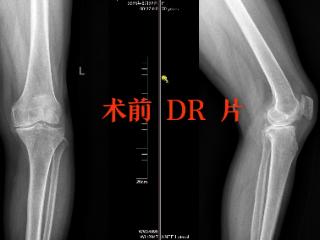 曹县中医医院成功独立开展首例膝关节内侧单髁置换手术