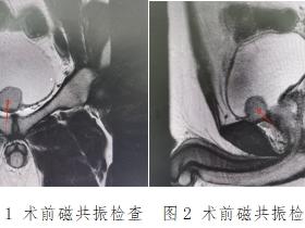 临沂市中医医院高铁院区泌尿外科微创手术治疗一例罕见膀胱异位嗜铬细胞瘤