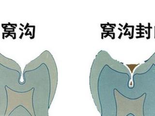 暑期护牙，免费牙齿窝沟封闭