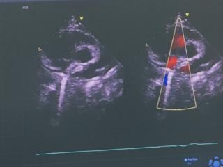 6岁女童体检发现“心脏漏洞” 南医大四附院微创可降解封堵术助其重获健康