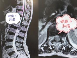 高龄并非手术禁区，八旬老人在“家门口”解决椎管肿瘤大难题