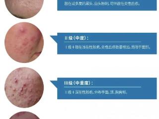 青岛西海岸第二医院暑期痤疮治疗半价，预约从速