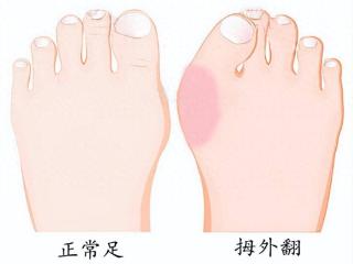 什么程度的拇外翻（大脚骨）需要矫正？关节外科专家详解