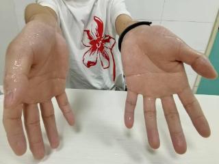 小叶医探 | 不敢与人握手，试卷被汗浸湿......20分钟手术让他告别“水手”困扰
