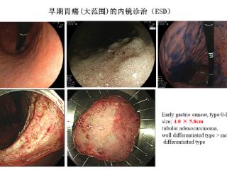 相马宁教授与内镜黏膜下剥离术：消化道早癌的微创根治术