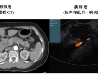 超声内镜（EUS）：胰腺癌诊断的关键利器