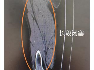 跨越千里迈向新生，内蒙古患者在滨州市人民医院重获行走自由
