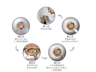 蔡司发明全球首个三焦点晶体 十年长效稳定脱镜率超90%
