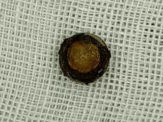 幼童鼻腔惊现纽扣电池，医生提醒：这类“迷你凶器”常见又危险