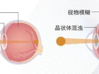 济南市眼科医院科普|夏日当心“晒出”白内障