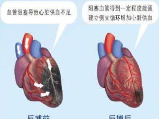 济南市三院：“躺赢”的心脏康复方案——体外反搏破解冠脉慢血流