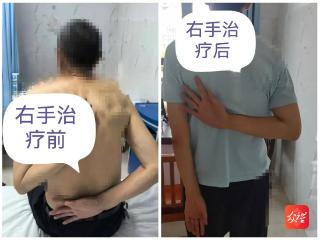超声精准引导+手法松解！玉屏人民医院创新疗法让“冻结肩”患者重获自如