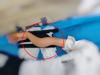 骨折又畏惧手术？这个门诊无创“手”护！