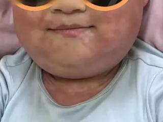 多学科协作：青岛市妇女儿童医院成功救治重症化脓性腮腺炎患儿