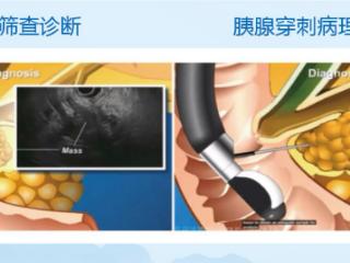 超声内镜赋能：济南南郊医院相马宁教授为胆胰早癌筛查精准 “导航”