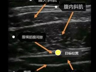 妇幼科普 | TAP阻滞：剖宫产妈妈的“隐形止痛贴”