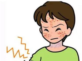夏日光敏性皮炎，如何科学用药？