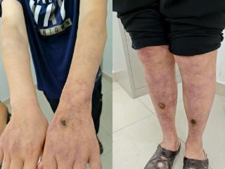 山东60岁大爷皮肤结了“蜘蛛网”？涂平教授为患者拨开病症迷雾