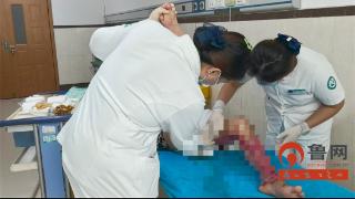 烟台市蓬莱人民医院成功救治一例双下肢烫伤合并感染患者