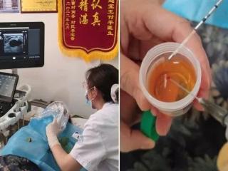 乳腺结节的精准向导——超声下乳腺结节穿刺术