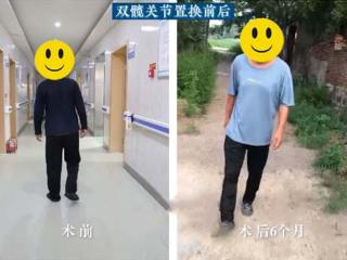 济南关节外科医院专病专治 潍坊五旬大哥重拾健康行走能力