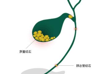 小叶医探 | 胆囊结石“掉”入胆总管 “双镜联合”为患者一次解决两处结石