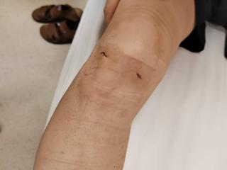 精准直击关节顽疾痛点！北京大学人民医院青岛医院常态化开展微创针刀镜技术
