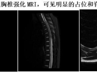 15岁少年突发截瘫，微创骨科急症手术半月助其站立行走