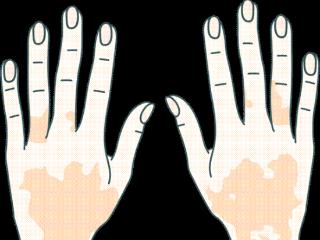 青少年308准分子激光治疗怎么治？济南中医白癜风医院一文解答