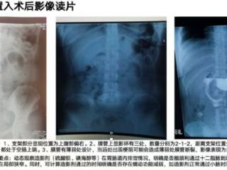 告别减重困境！济南南郊医院消化内科胃转流支架助你科学减重